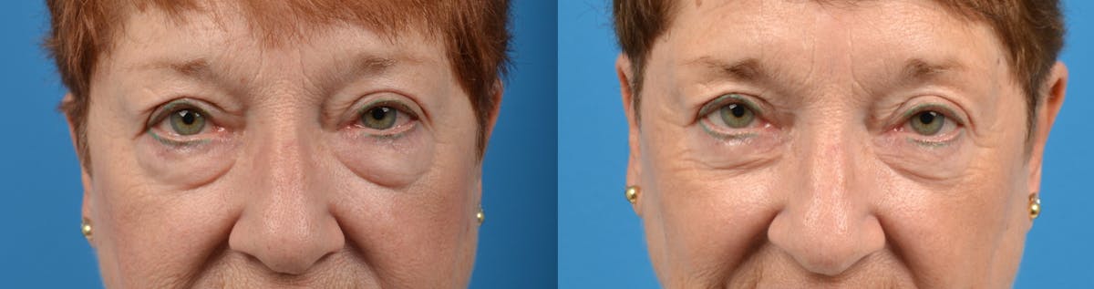 Eyelid Surgery Before & After Gallery - Patient 122405679 - Image 1