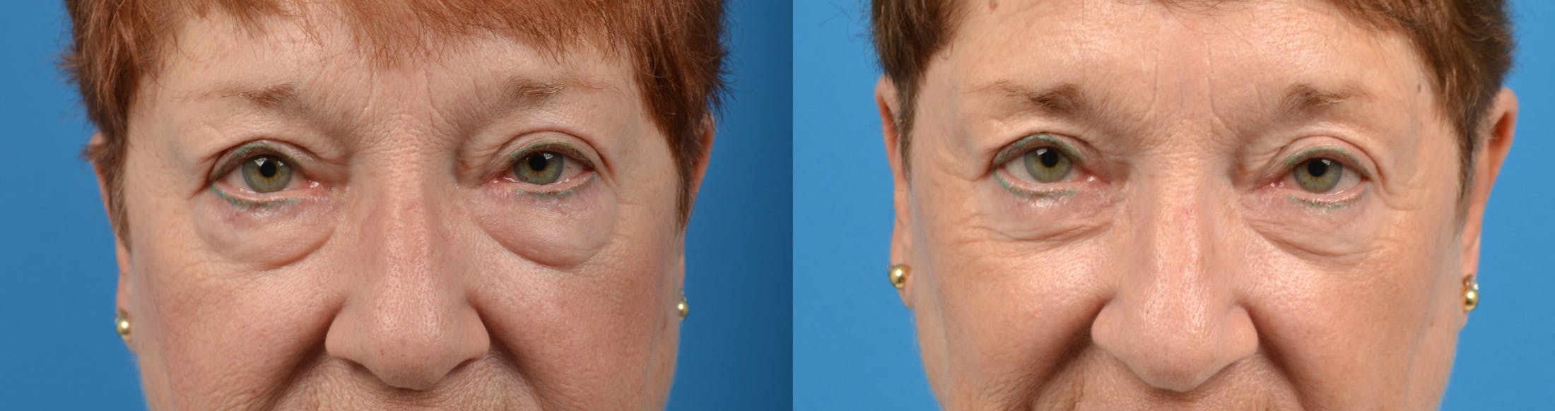 Eyelid Surgery Before & After Gallery - Patient 122405679 - Image 1
