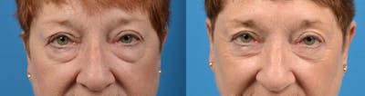 Eyelid Surgery Before & After Gallery - Patient 122405679 - Image 1
