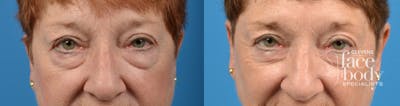 Eyelid Surgery Before & After Gallery - Patient 265450 - Image 1