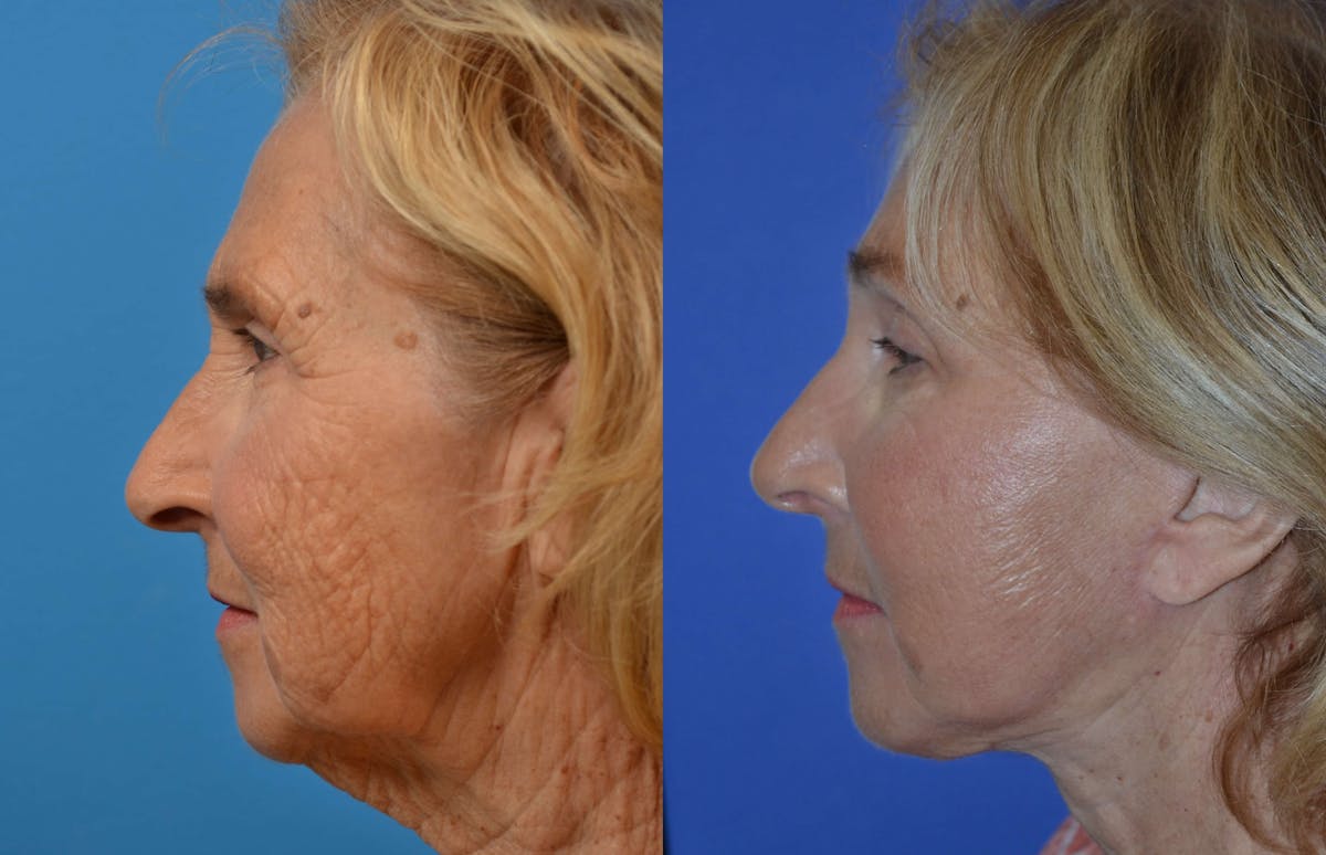 Facelift Before & After Gallery - Patient 122405681 - Image 2