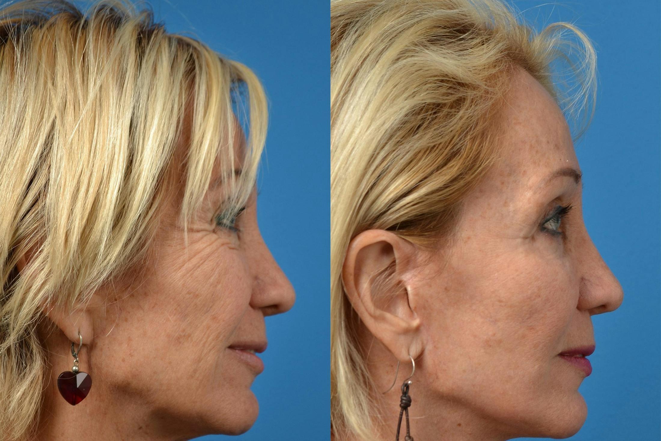 Dermal Fillers Before & After Gallery - Patient 122405678 - Image 4