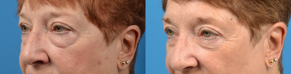 Eyelid Surgery Before & After Gallery - Patient 122405679 - Image 2