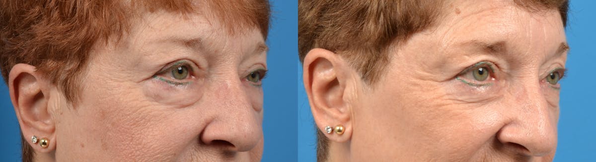 Eyelid Surgery Before & After Gallery - Patient 122405679 - Image 3