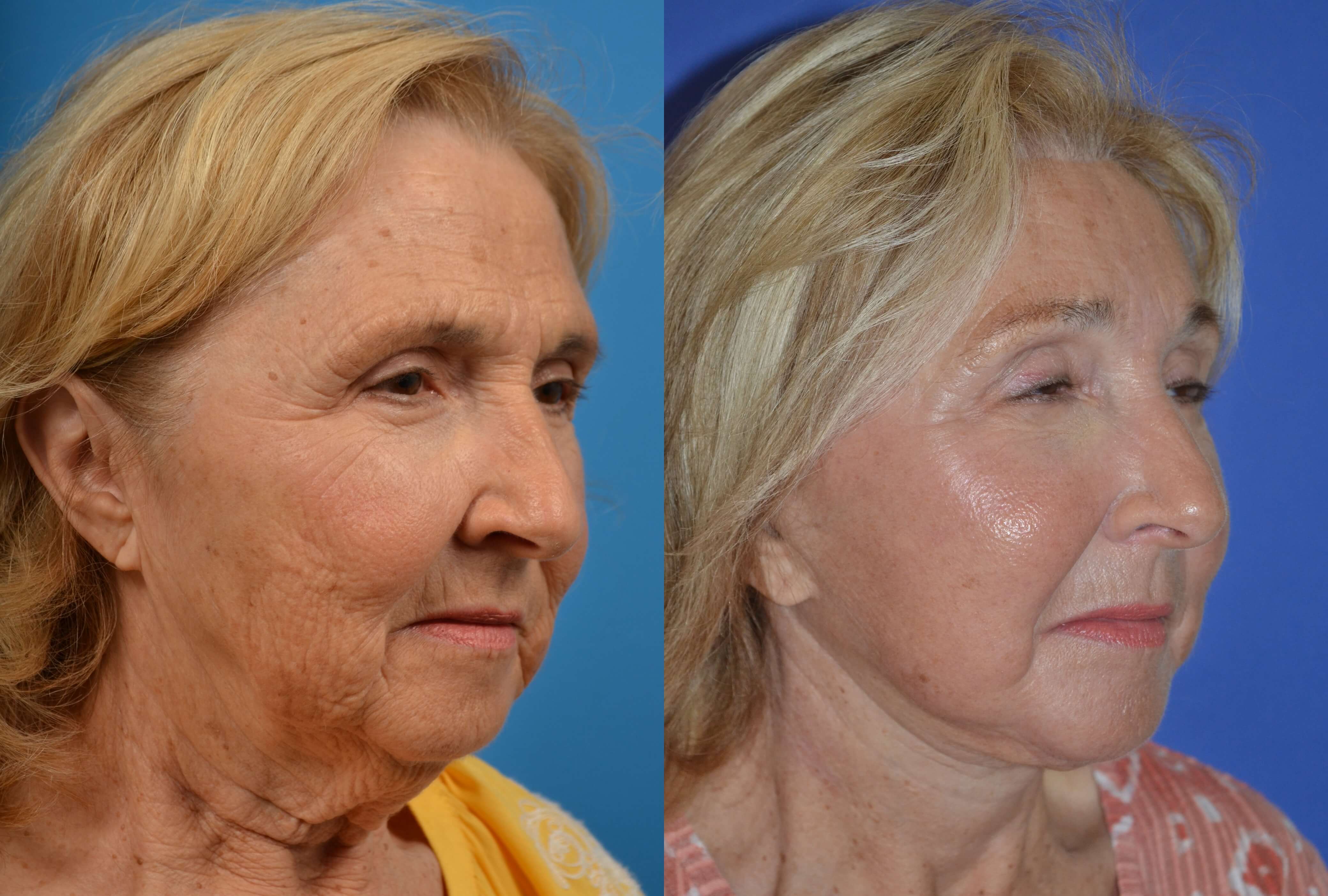 Facelift Before & After Gallery - Patient 122405681 - Image 4