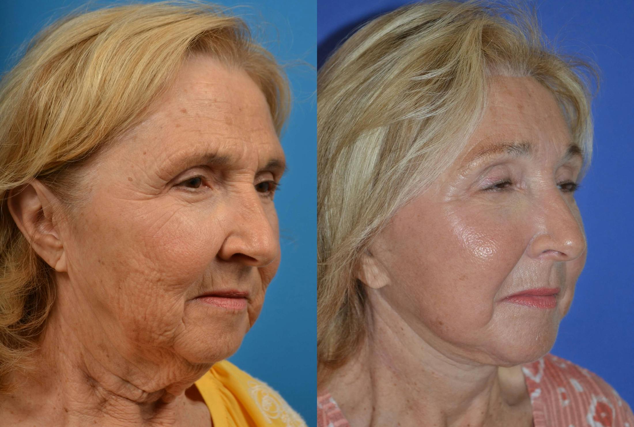 Facelift Before & After Gallery - Patient 122405681 - Image 4