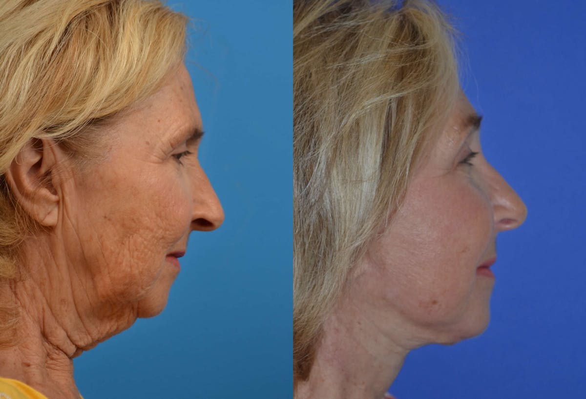 Facelift Before & After Gallery - Patient 122405681 - Image 5