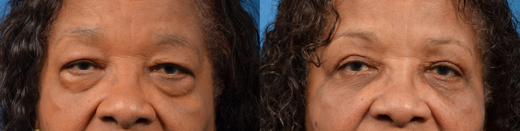 Eyelid Surgery Before & After Gallery - Patient 122405683 - Image 1