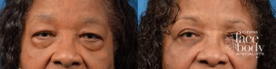 Eyelid Surgery Before & After Gallery - Patient 348732 - Image 1