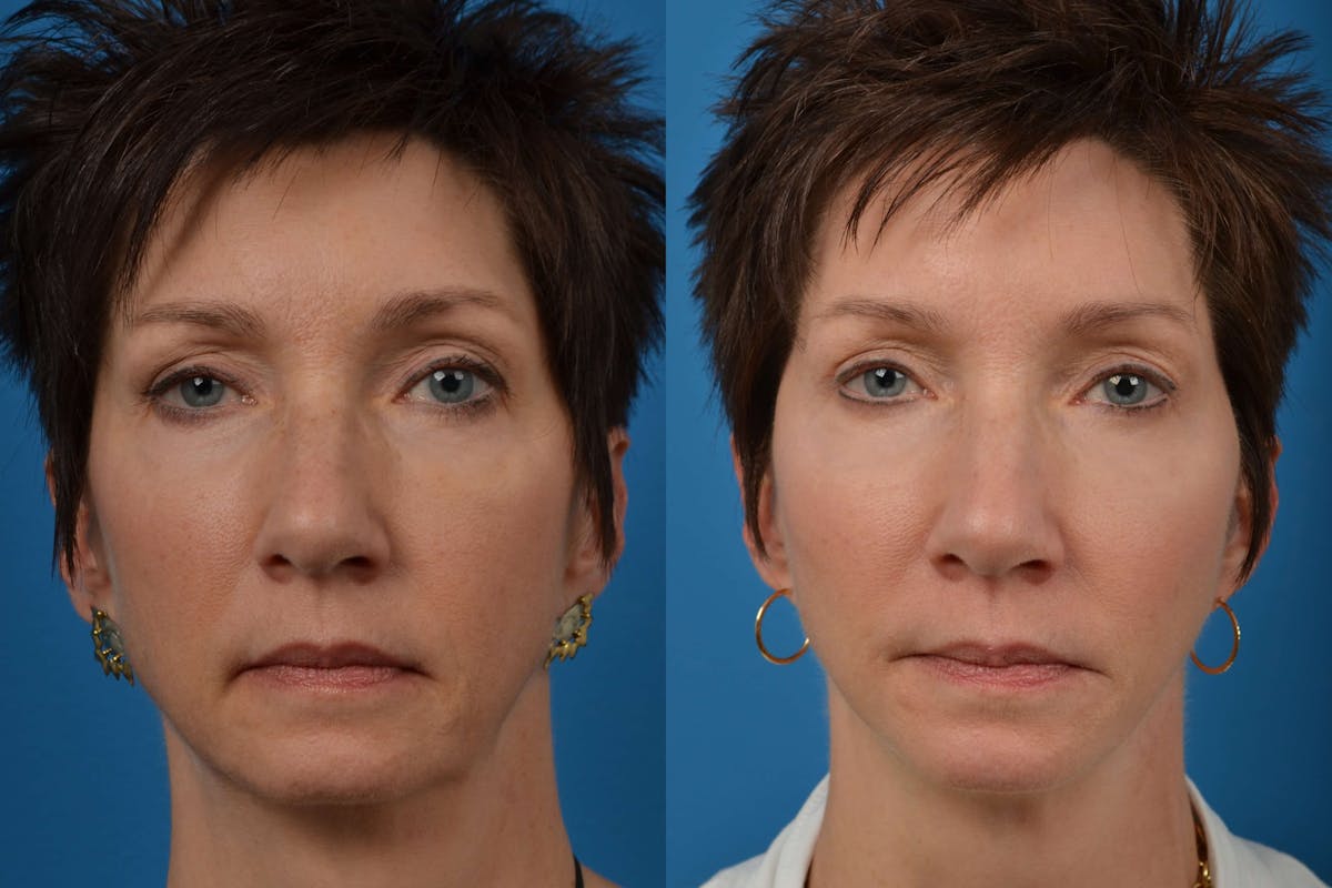 Facial Implant Before & After Gallery - Patient 122405686 - Image 1