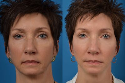 Facial Implant Before & After Gallery - Patient 122405686 - Image 1