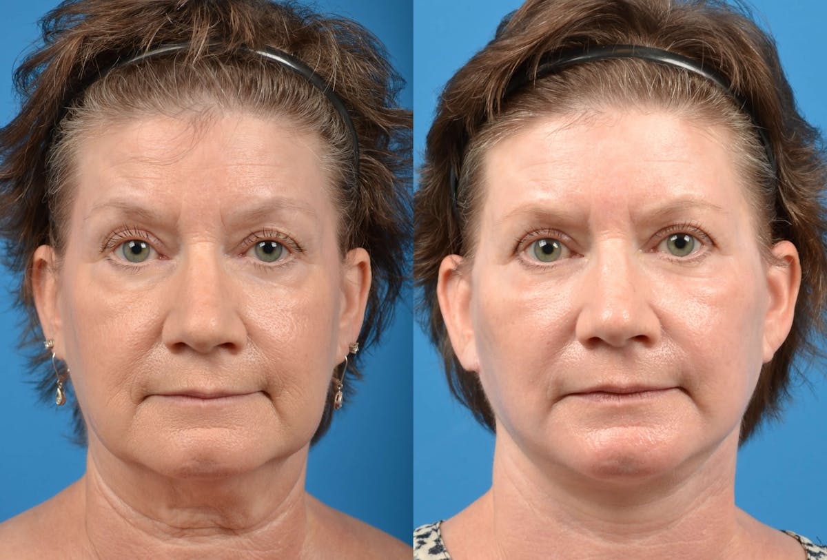 Facelift Before & After Gallery - Patient 122405688 - Image 1