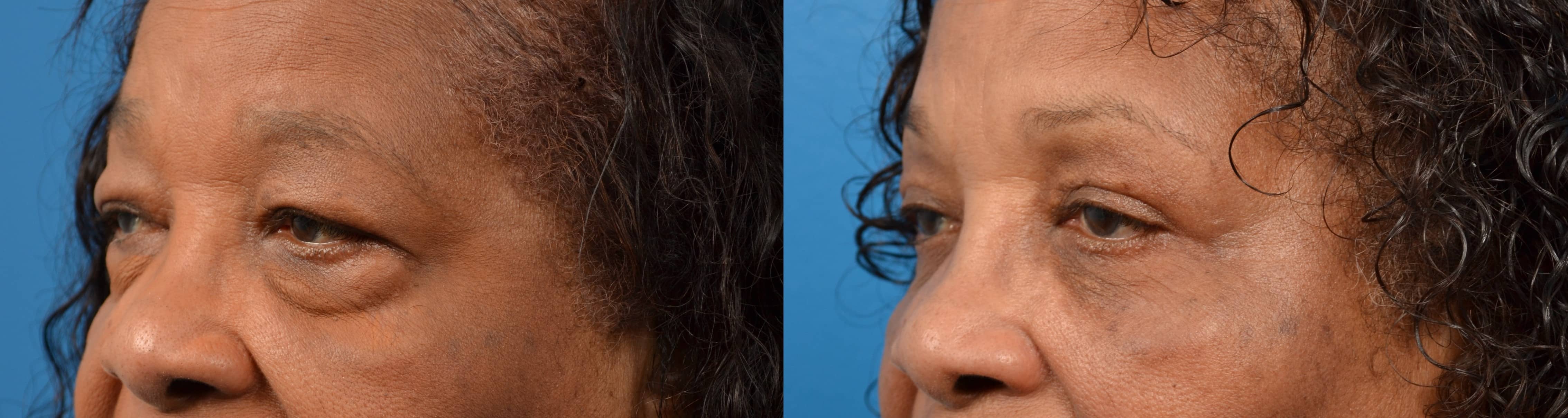 Eyelid Surgery Before & After Gallery - Patient 348732 - Image 2
