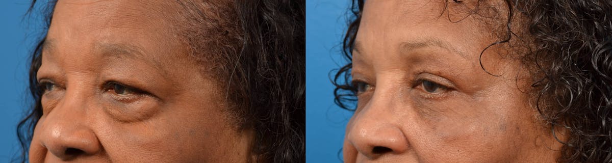 Eyelid Surgery Before & After Gallery - Patient 122405683 - Image 2