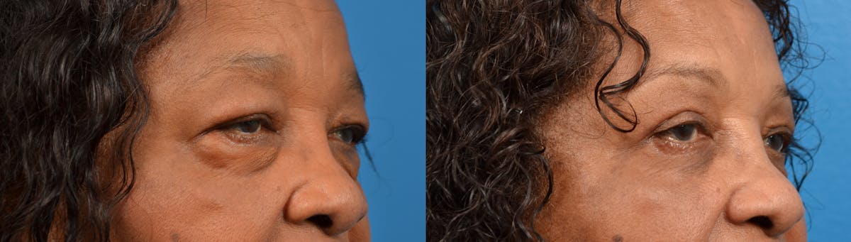 Eyelid Surgery Before & After Gallery - Patient 122405683 - Image 3