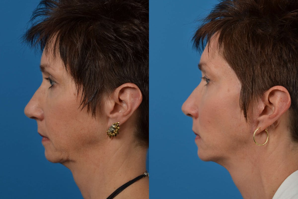 Facial Implant Before & After Gallery - Patient 122405686 - Image 2