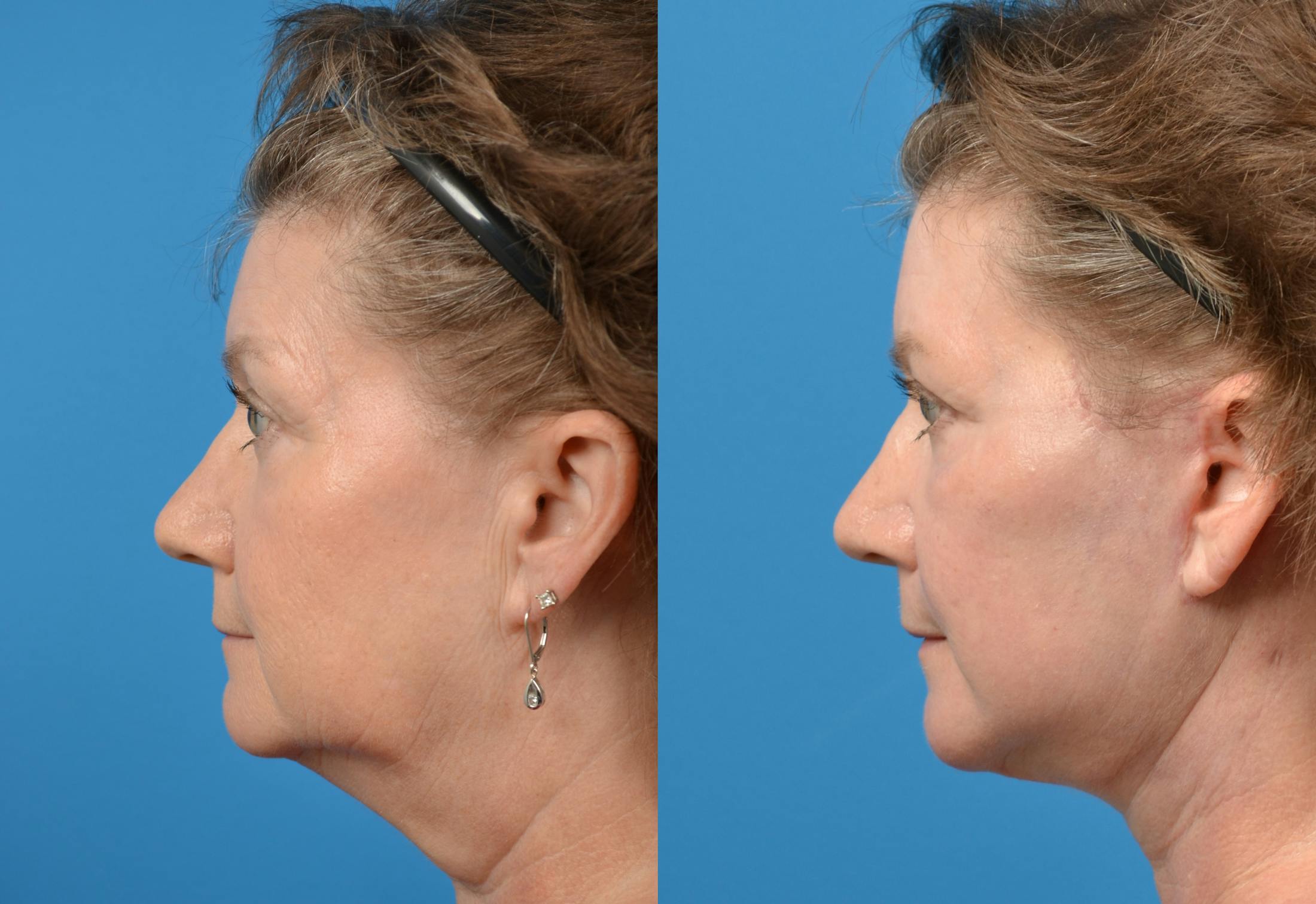Facelift Before & After Gallery - Patient 122405688 - Image 2