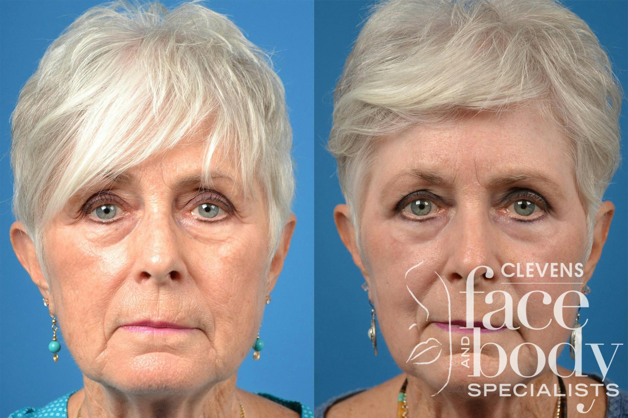 Dermal Fillers