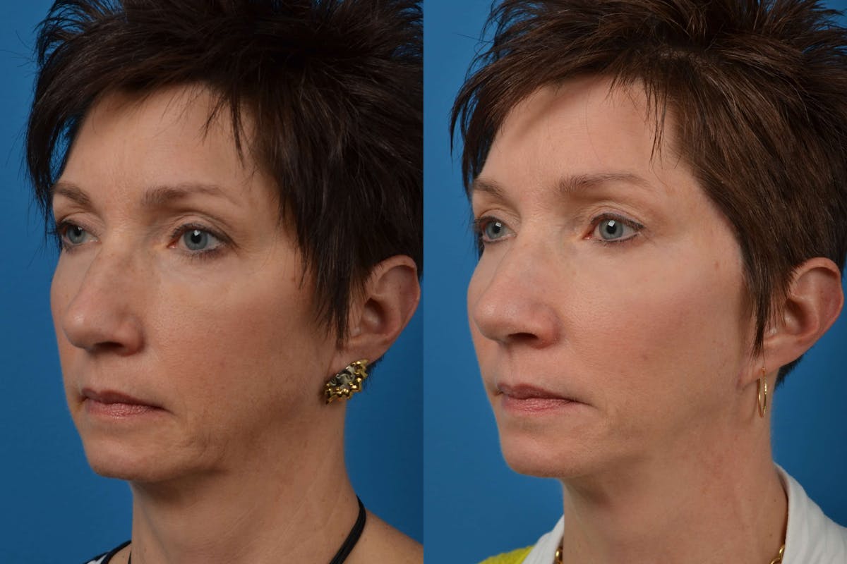 Facial Implant Before & After Gallery - Patient 122405686 - Image 3