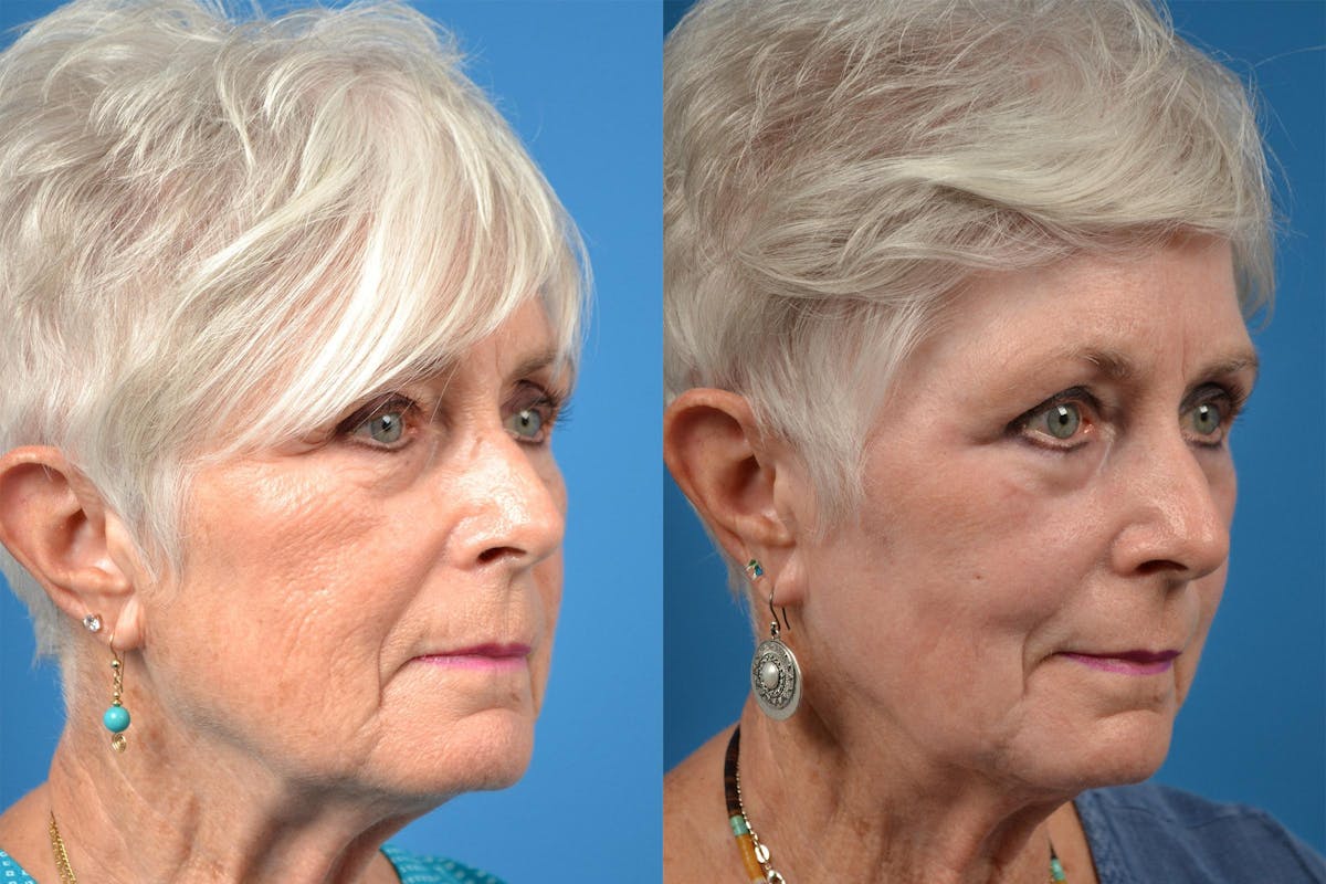 Dermal Fillers Before & After Gallery - Patient 122405690 - Image 2