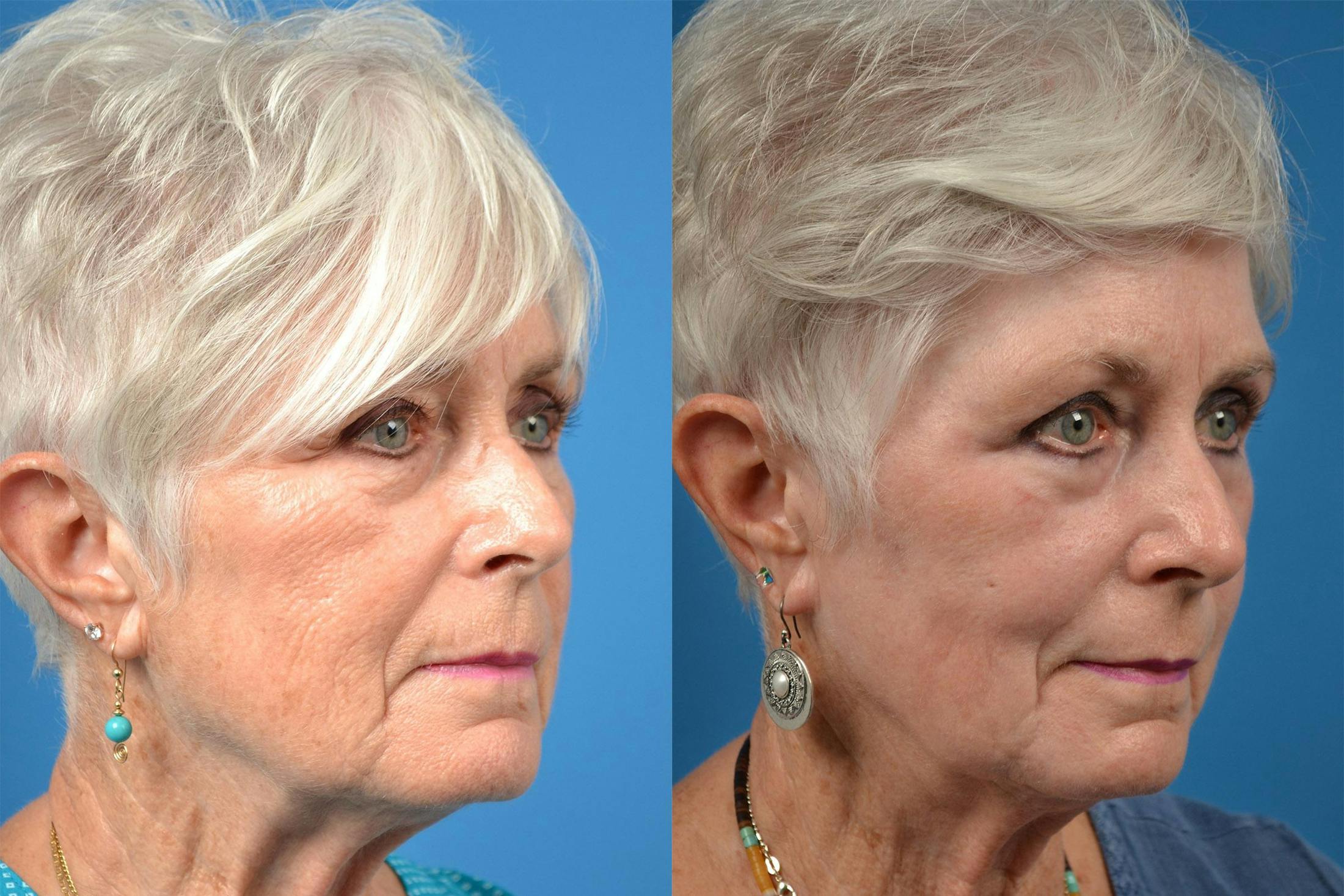 Dermal Fillers Before & After Gallery - Patient 122405690 - Image 2