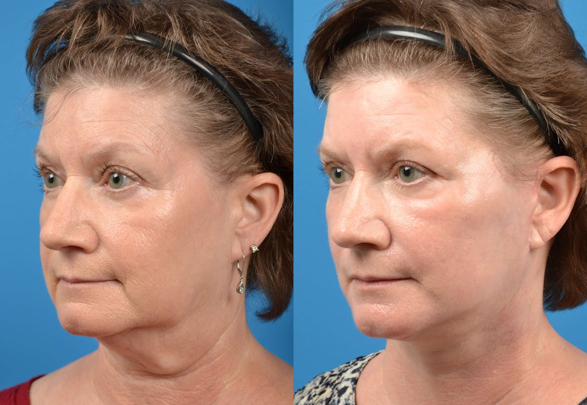 Facelift Before & After Gallery - Patient 122405688 - Image 3