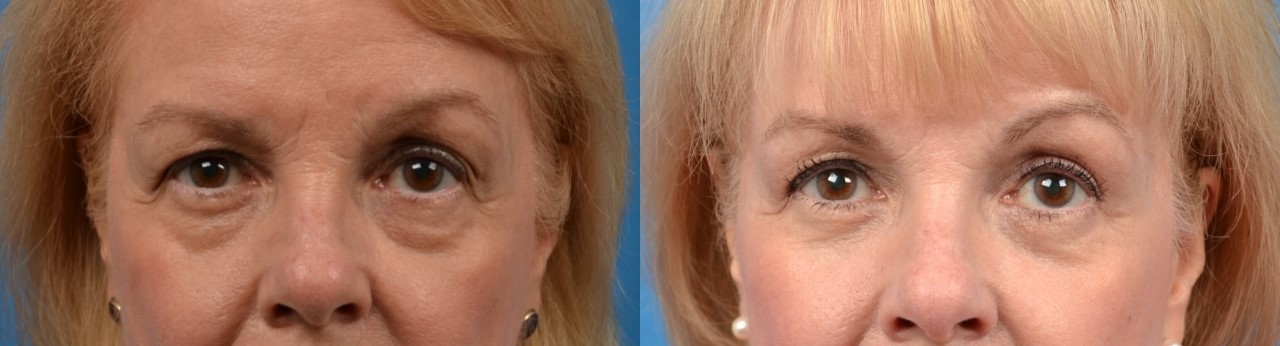 Eyelid Surgery Before & After Gallery - Patient 169871 - Image 1