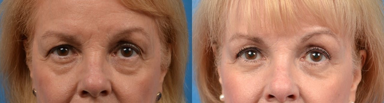 Eyelid Surgery Before & After Gallery - Patient 122405687 - Image 1