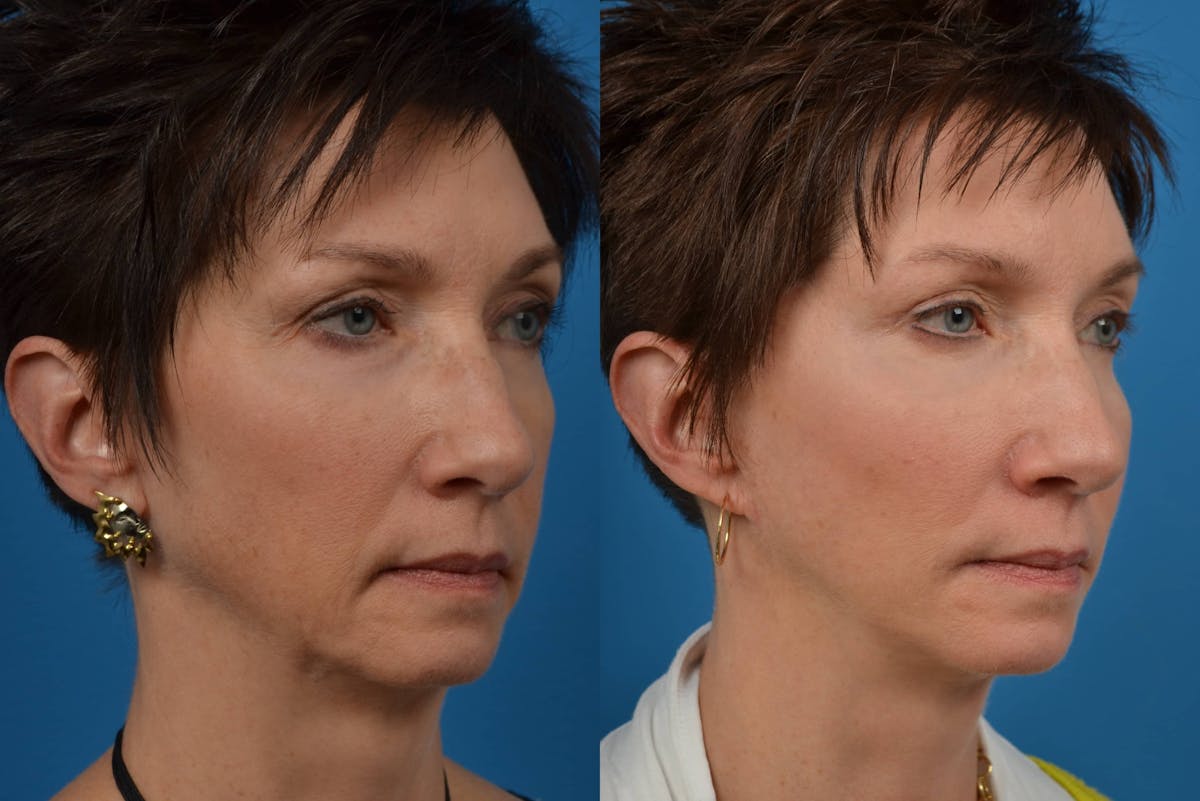 Facial Implant Before & After Gallery - Patient 122405686 - Image 4