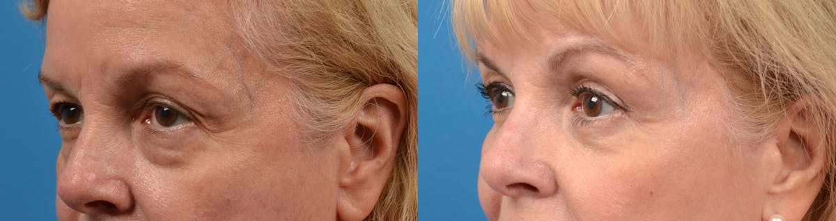 Eyelid Surgery Before & After Gallery - Patient 122405687 - Image 2
