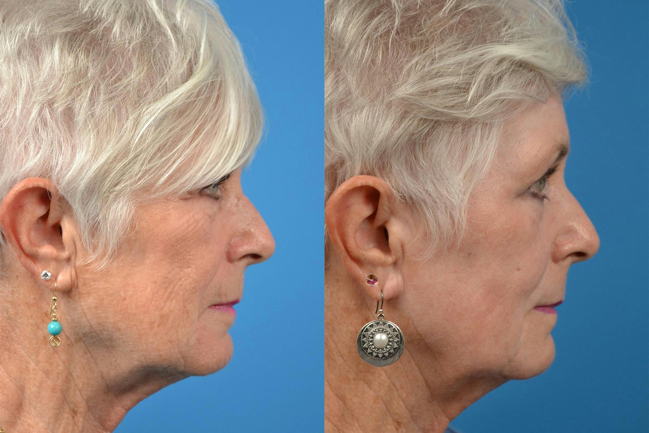 Dermal Fillers Before & After Gallery - Patient 122405690 - Image 3