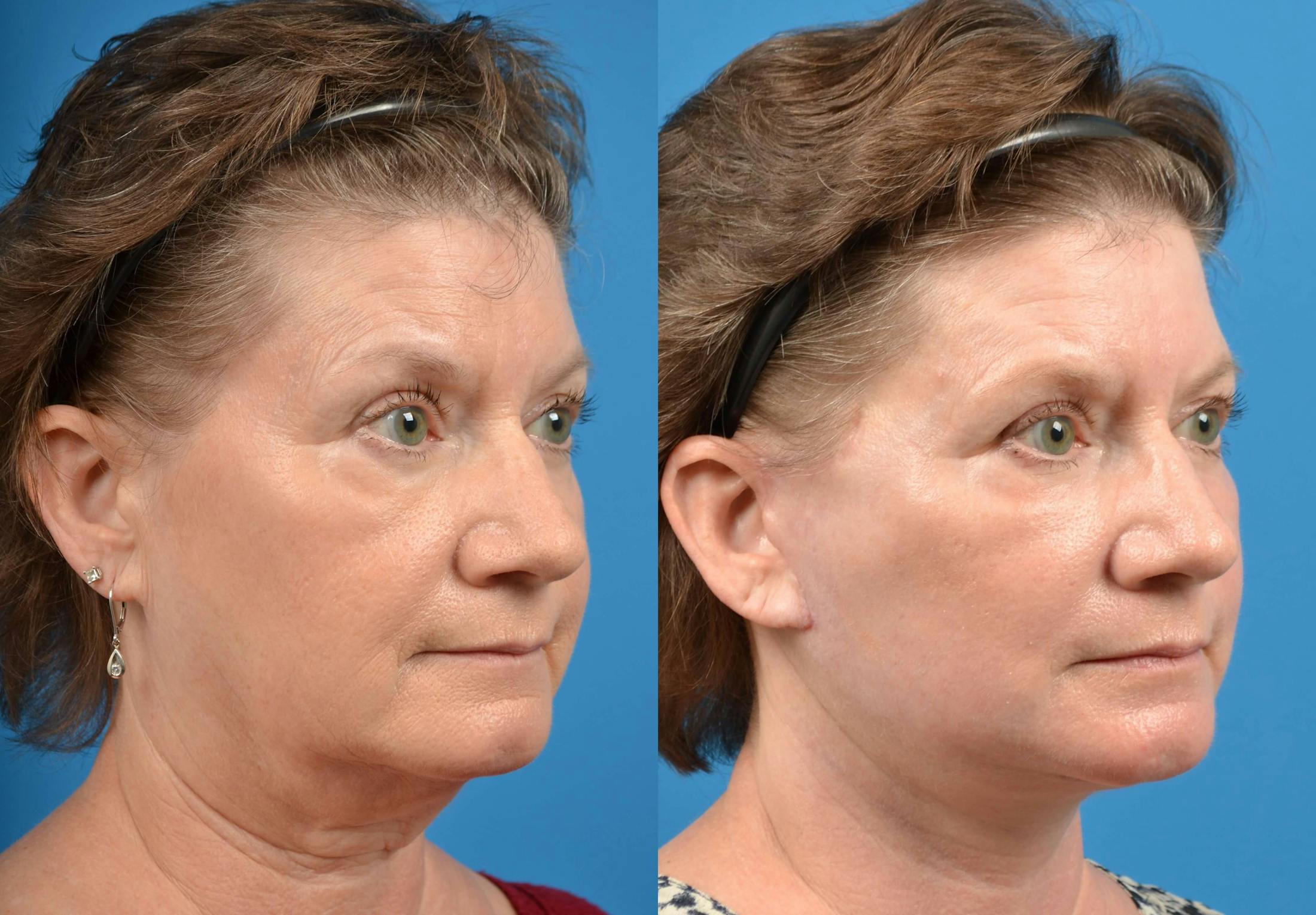 Facelift Before & After Gallery - Patient 122405688 - Image 4