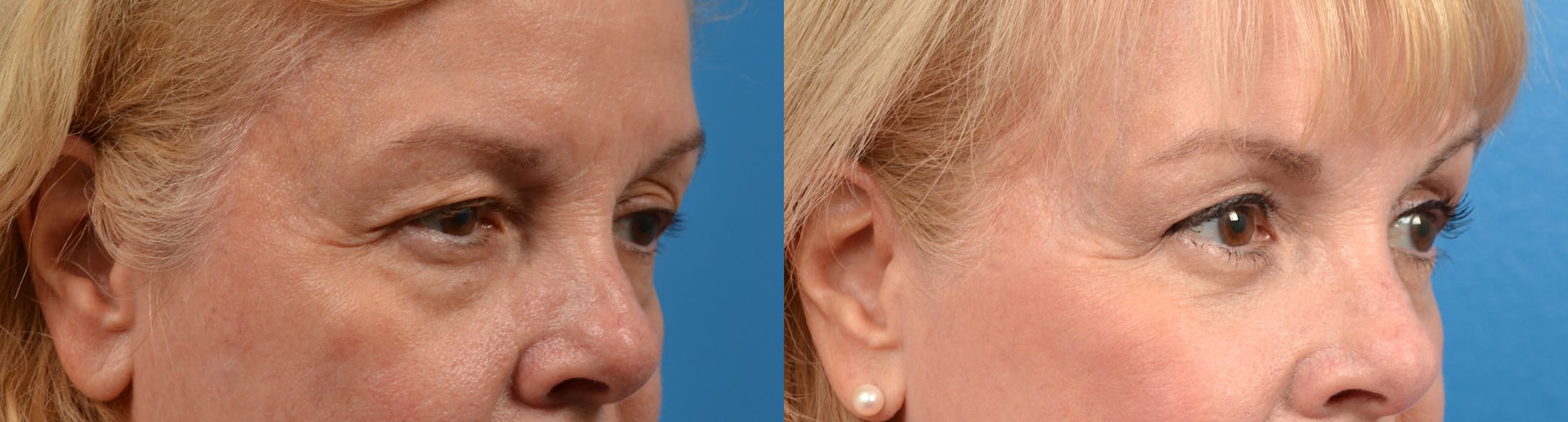 Eyelid Surgery Before & After Gallery - Patient 122405687 - Image 3