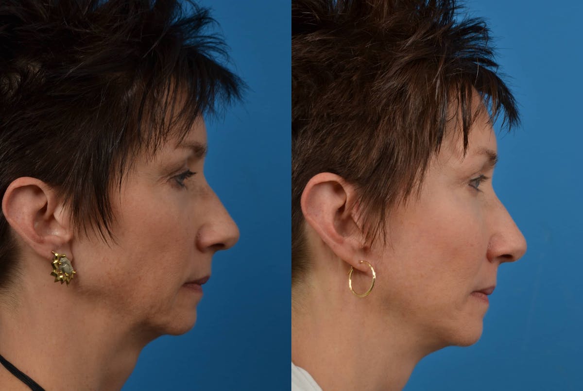 Facial Implant Before & After Gallery - Patient 122405686 - Image 5