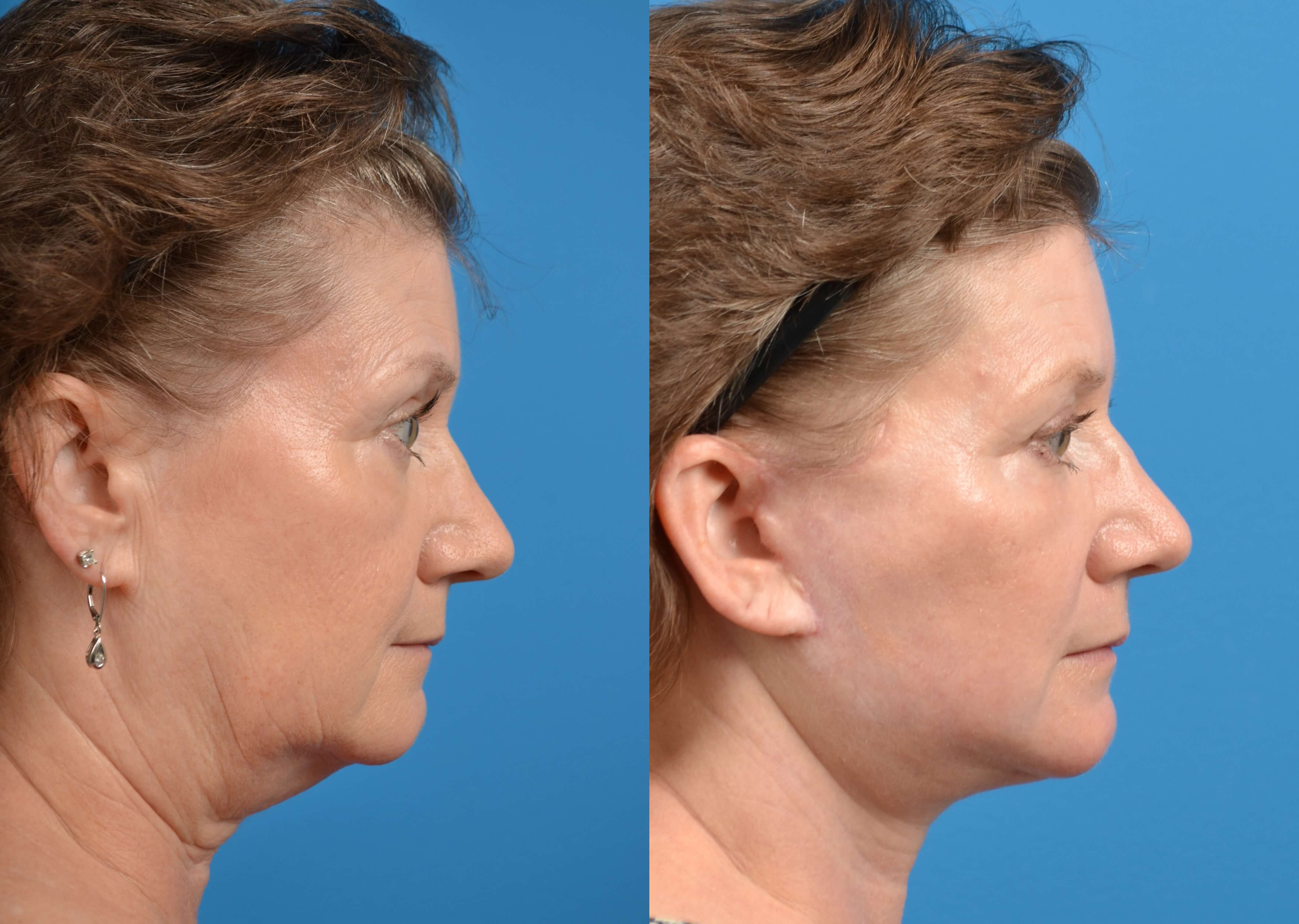Facelift Before & After Gallery - Patient 122405688 - Image 5