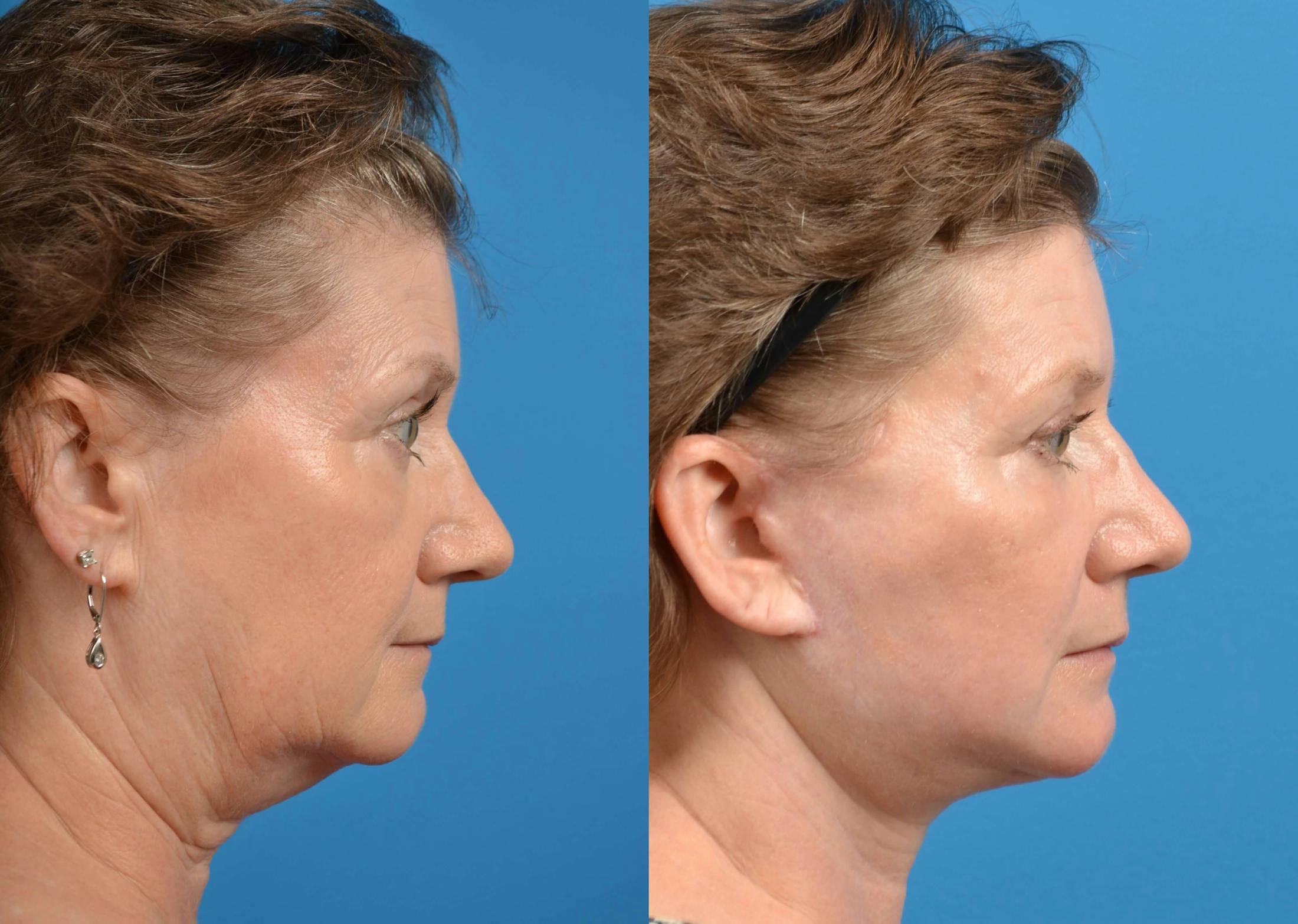 Facelift Before & After Gallery - Patient 122405688 - Image 5