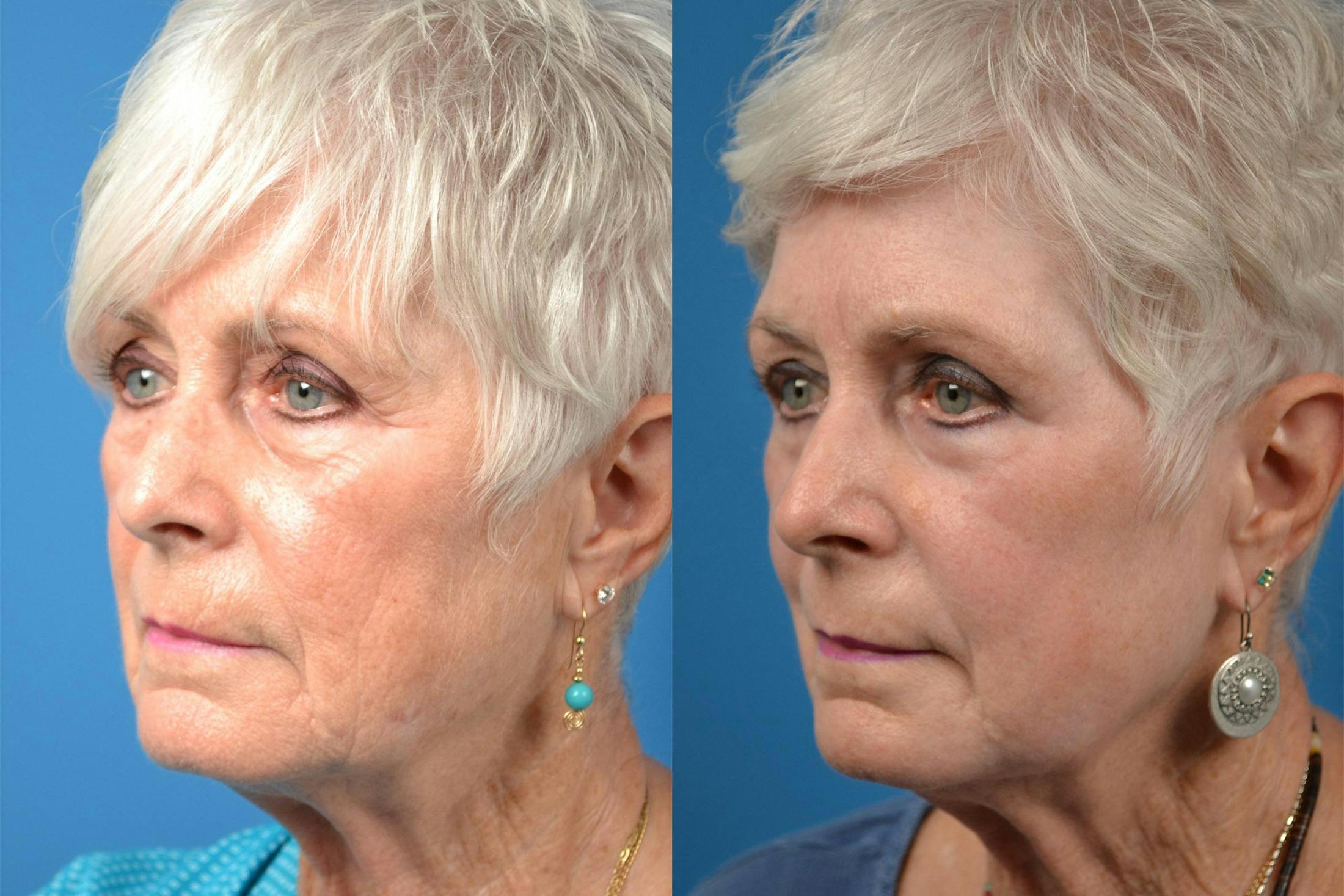 Dermal Fillers Before & After Gallery - Patient 122405690 - Image 4
