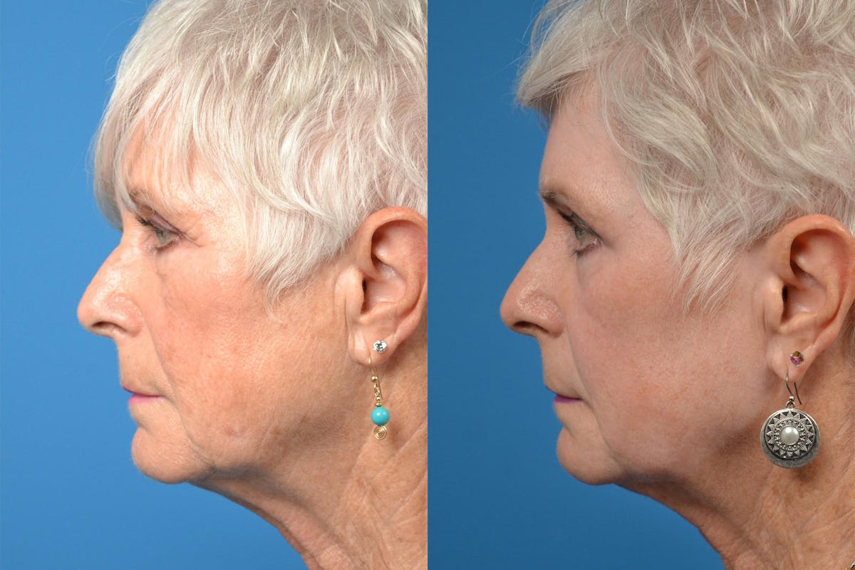 Dermal Fillers Before & After Gallery - Patient 122405690 - Image 5