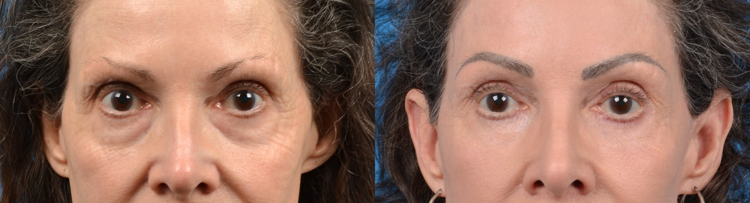 Eyelid Surgery Before & After Gallery - Patient 412777 - Image 1