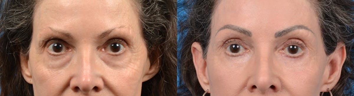 Eyelid Surgery Before & After Gallery - Patient 122405689 - Image 1