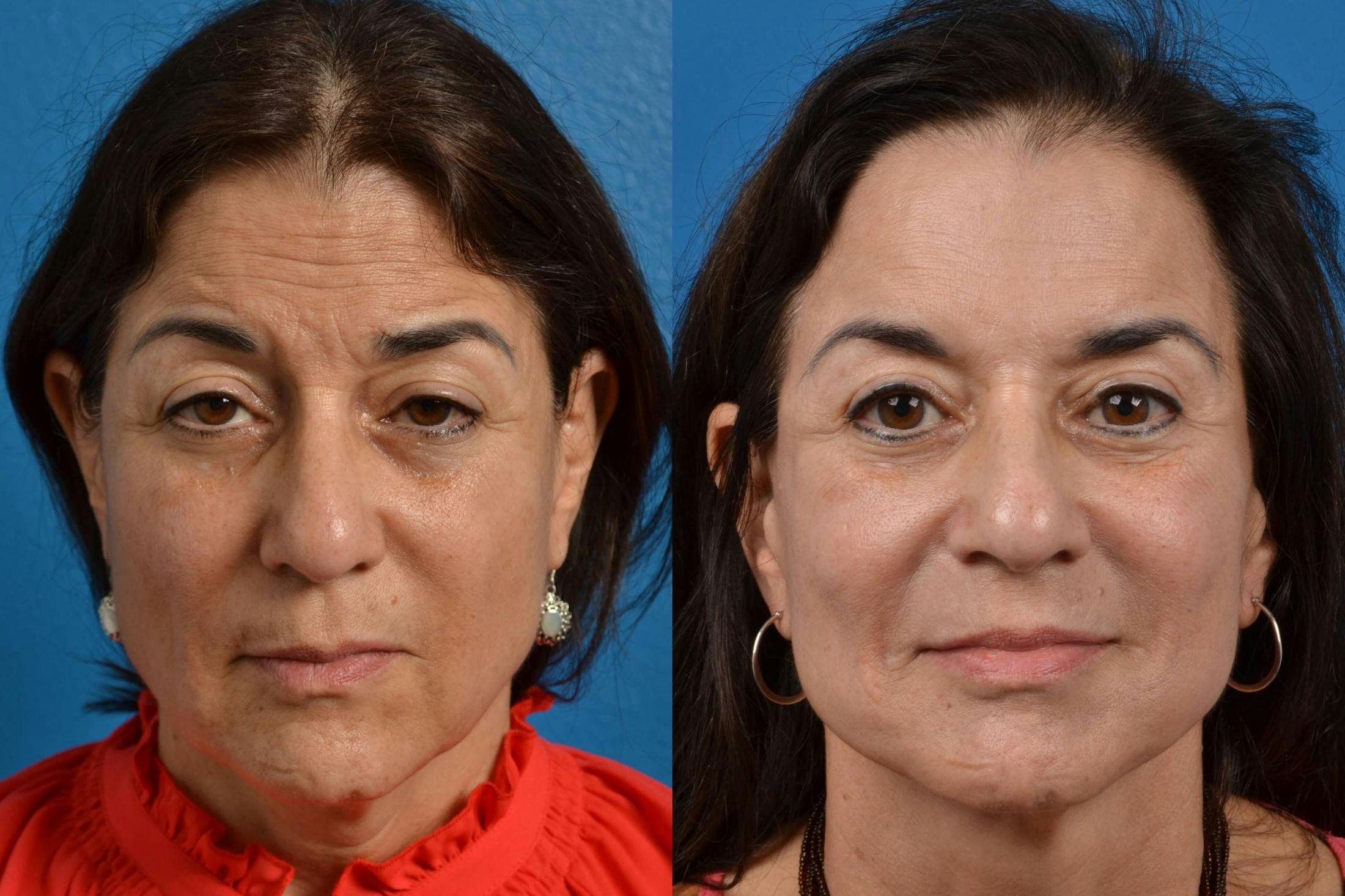 Facelift Before & After Gallery - Patient 122405694 - Image 1