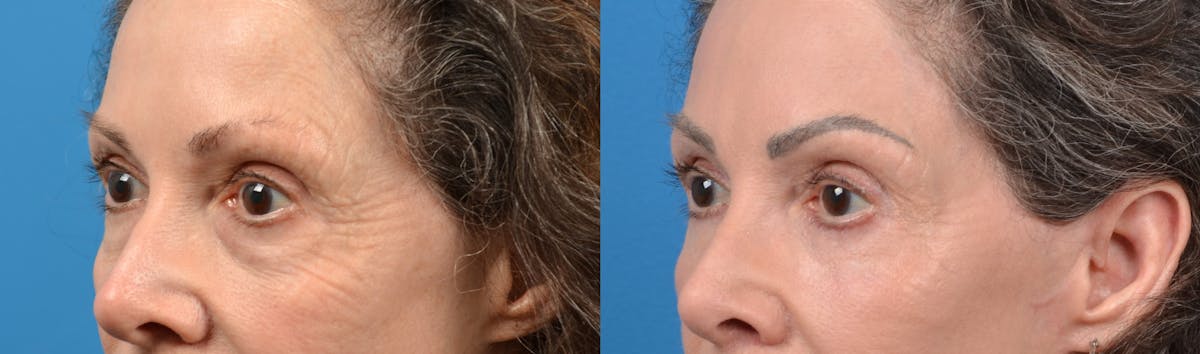 Eyelid Surgery Before & After Gallery - Patient 122405689 - Image 2