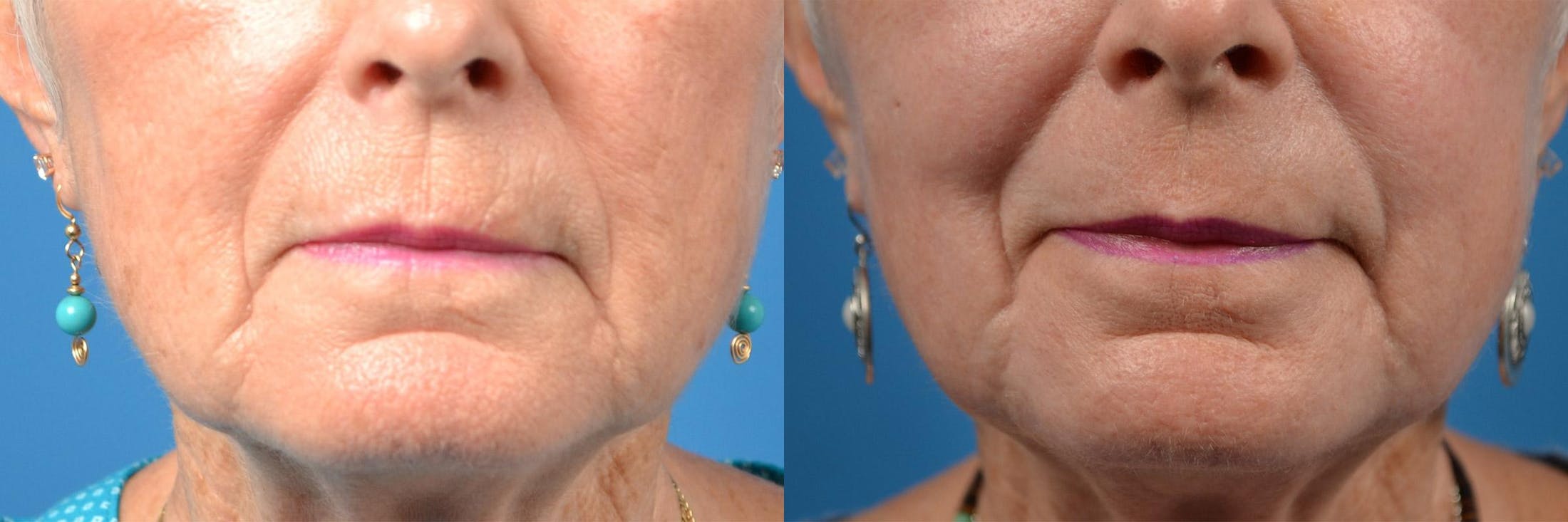 Dermal Fillers Before & After Gallery - Patient 122405690 - Image 6