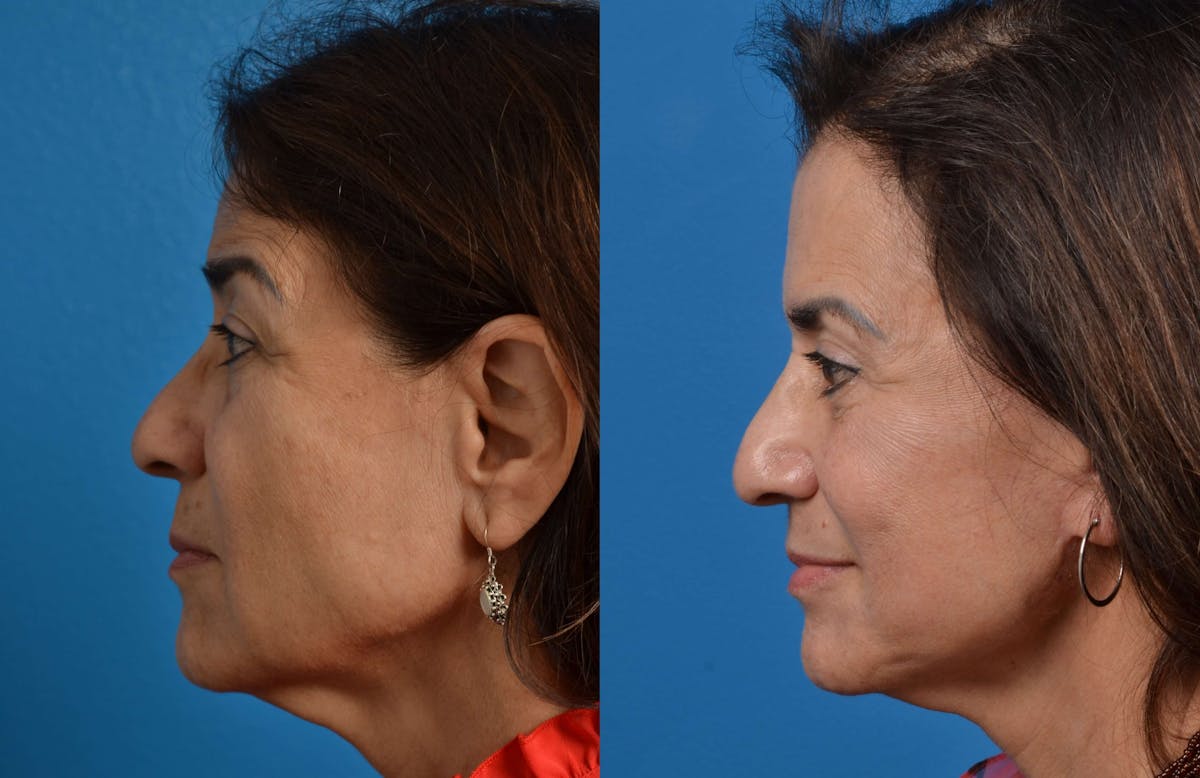 Facelift Before & After Gallery - Patient 122405694 - Image 2