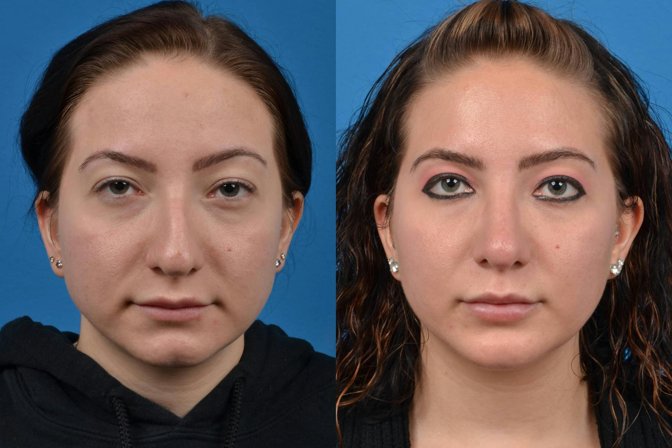 Facial Implant Gallery - Patient 122405691 - Image 3
