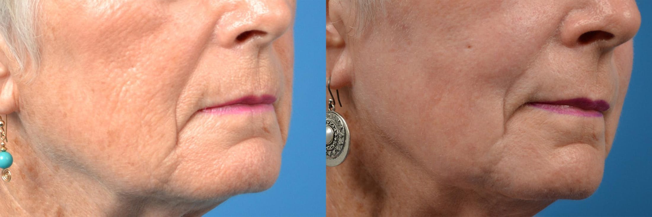 Dermal Fillers Before & After Gallery - Patient 122405690 - Image 7