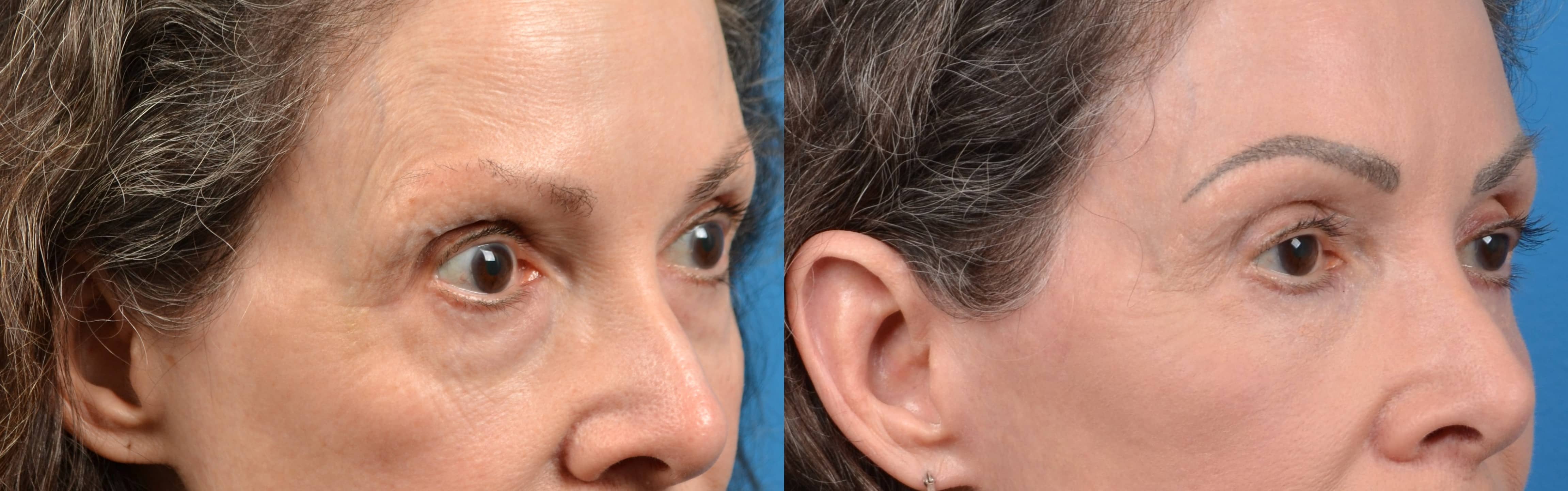 Eyelid Surgery Before & After Gallery - Patient 412777 - Image 3