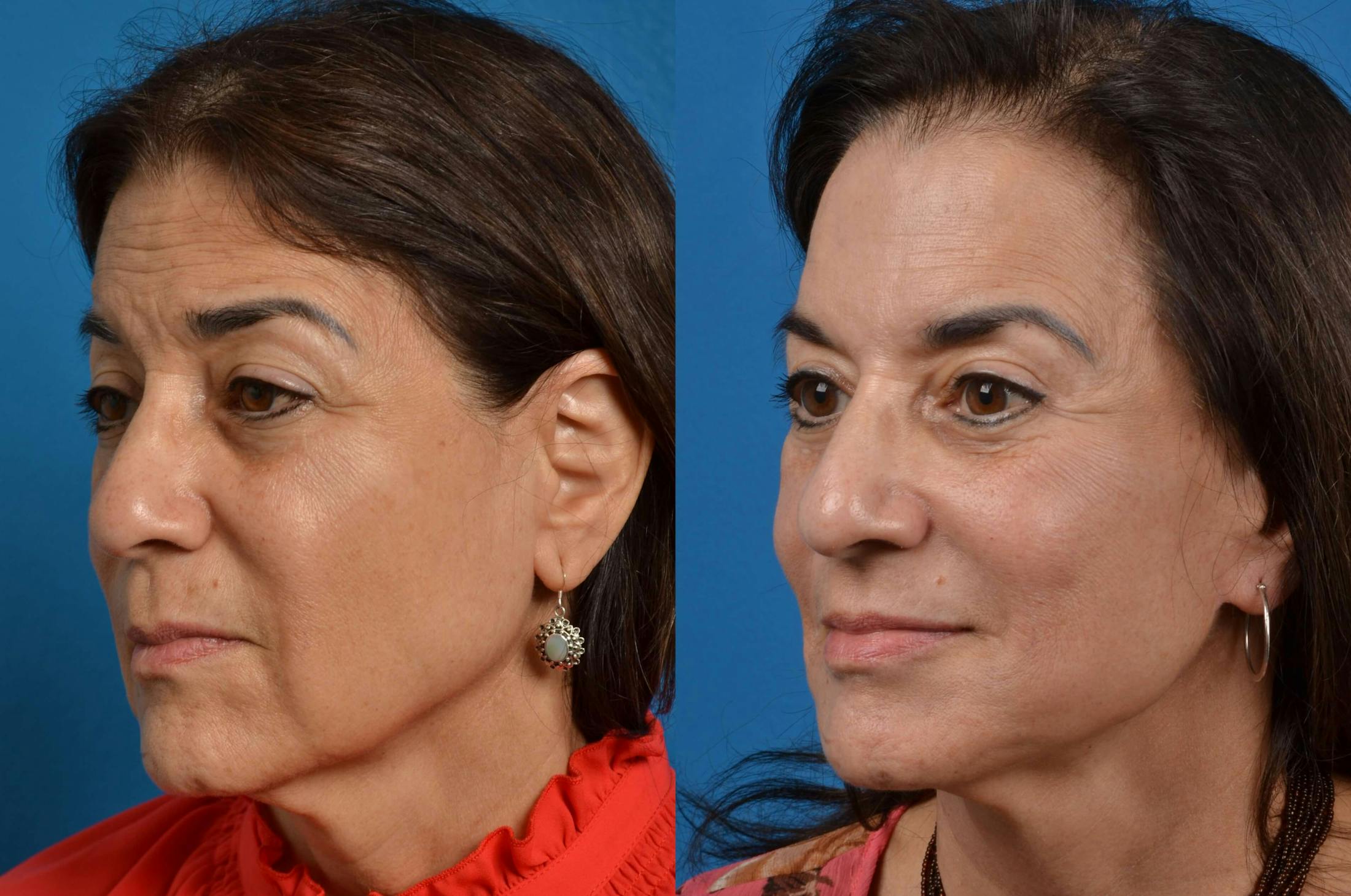 Facelift Before & After Gallery - Patient 122405694 - Image 3
