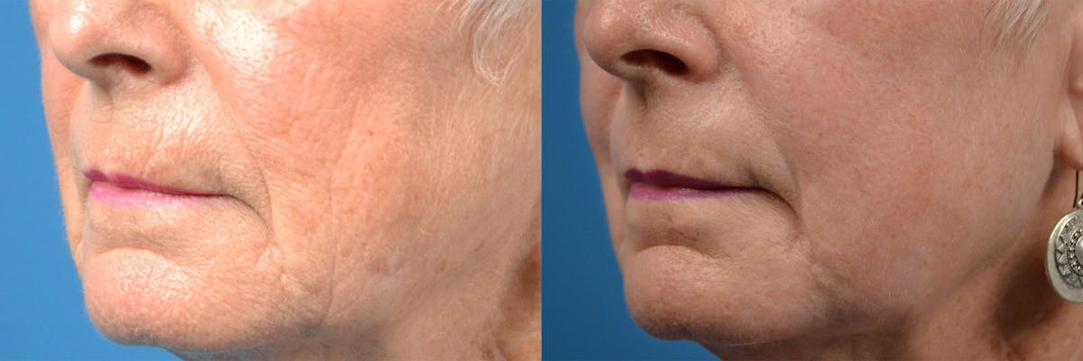 Dermal Fillers Before & After Gallery - Patient 122405690 - Image 8