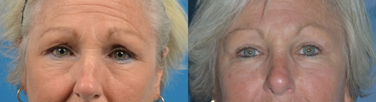 Eyelid Surgery Before & After Gallery - Patient 122405695 - Image 1